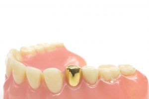 歯と歯茎のサンプル
