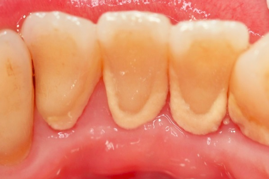 歯の内側に歯垢がついている写真