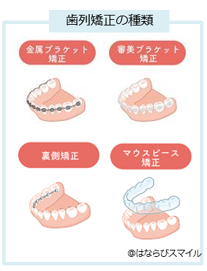 歯列矯正種類