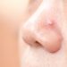 鼻の吹き出物は症状別で原因が分かる！治す方法を解説します。